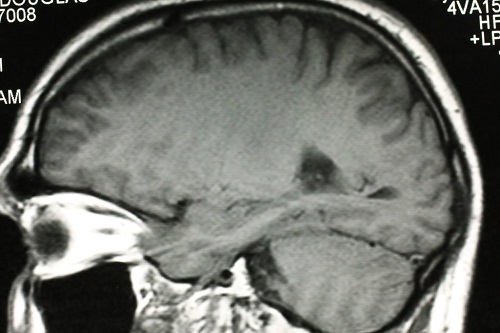 Thuốc chống sốt rét làm tăng điều trị glioblastoma